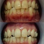 ビューティースマイル使用実例２