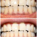 ビューティースマイル使用実例４