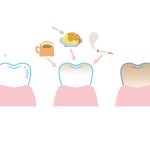 ホワイトニングの後戻りについて